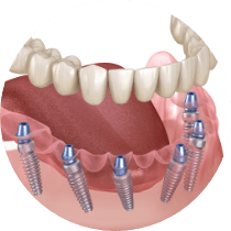 Image of removable dentures top and bottom
