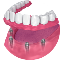 Image of removable dentures top and bottom