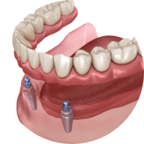 Image of removable dentures top and bottom