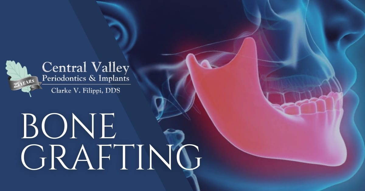 Bone Grafting — Periodontist — Modesto, CA — Clarke V. Filippi, DDS